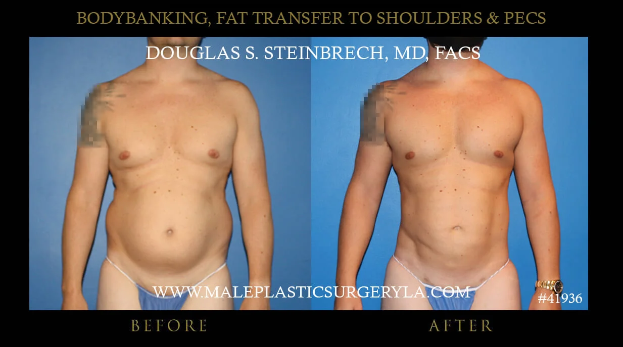 Liposuction - Before & After Photos