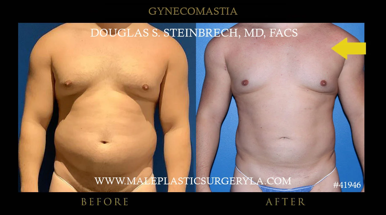 Gynecomastia - Before & After Photos