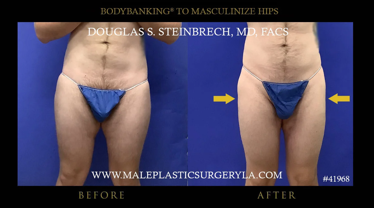 Liposuction - Before & After Photos