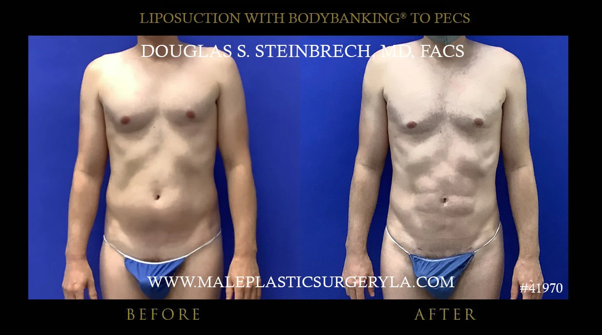 Liposuction - Before & After Photos