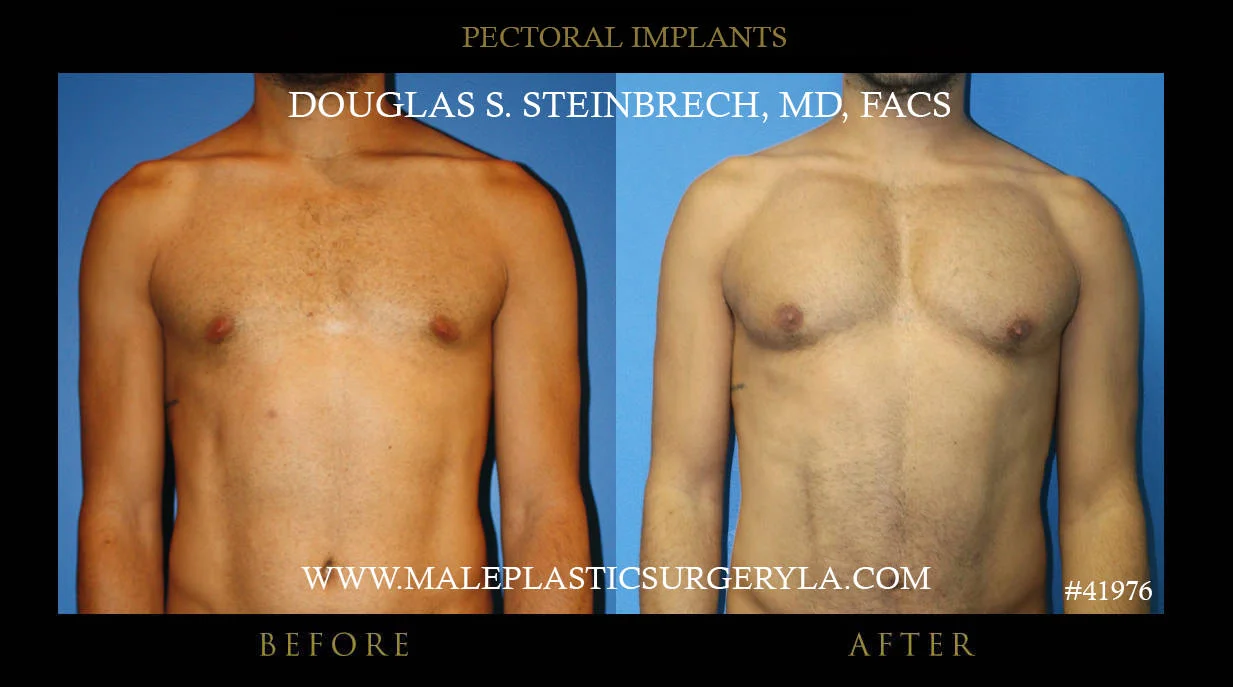 Pectoral Chest Implant - Before & After Photos