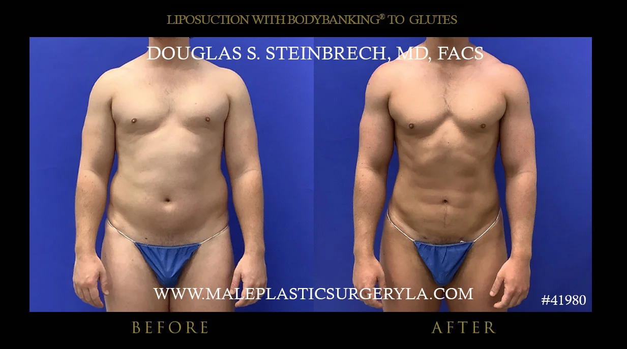 Liposuction - Before & After Photos