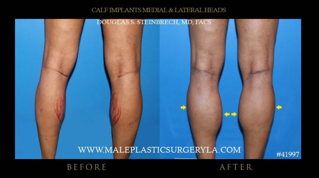 Calf Implants Before and After Photos