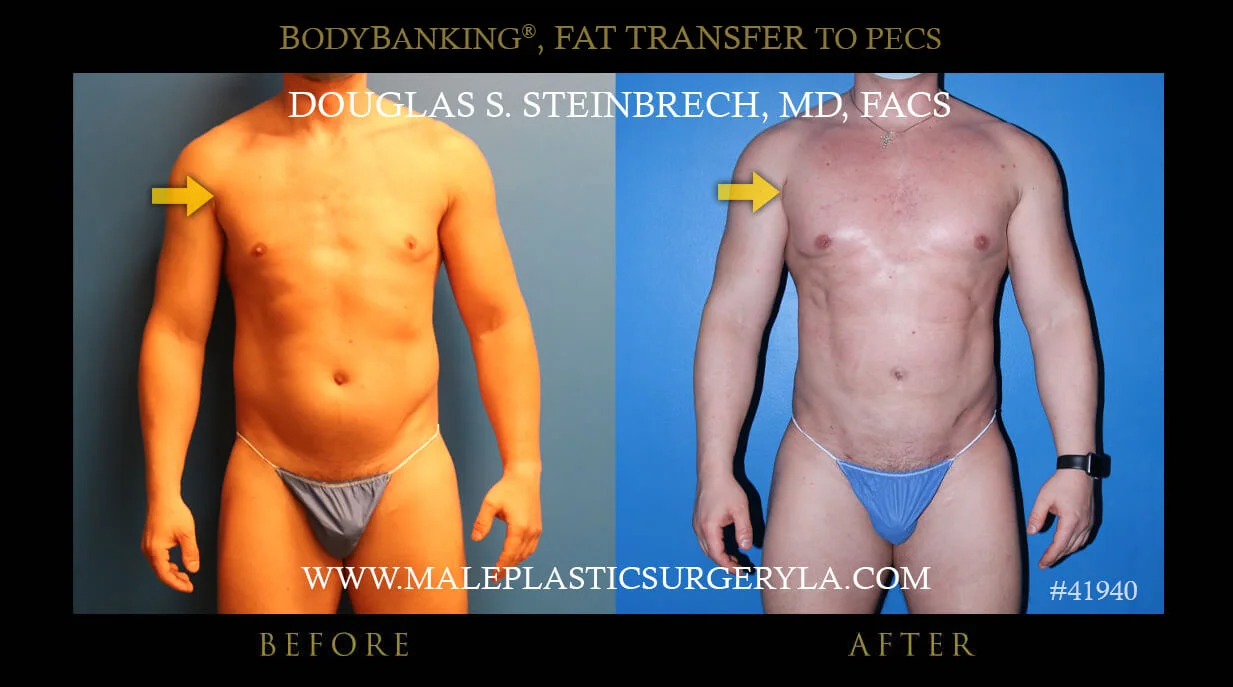 Liposuction - Before & After Photos