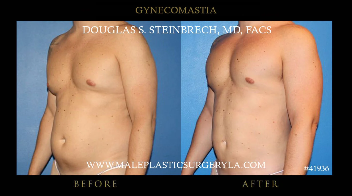 Gynecomastia - Before & After Photos