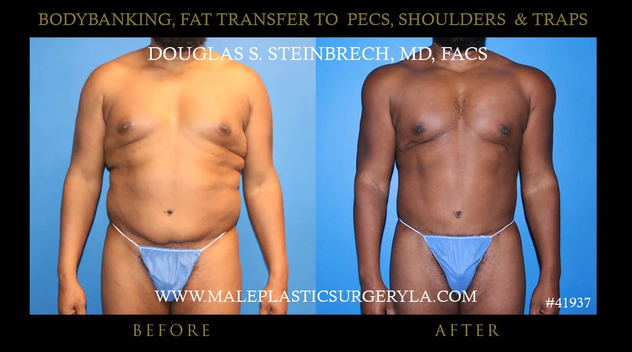 Liposuction - Before & After Photos