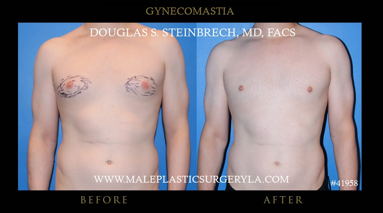 Gynecomastia - Before & After Photos