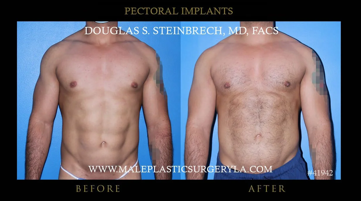 Pectoral Chest Implant - Before & After Photos