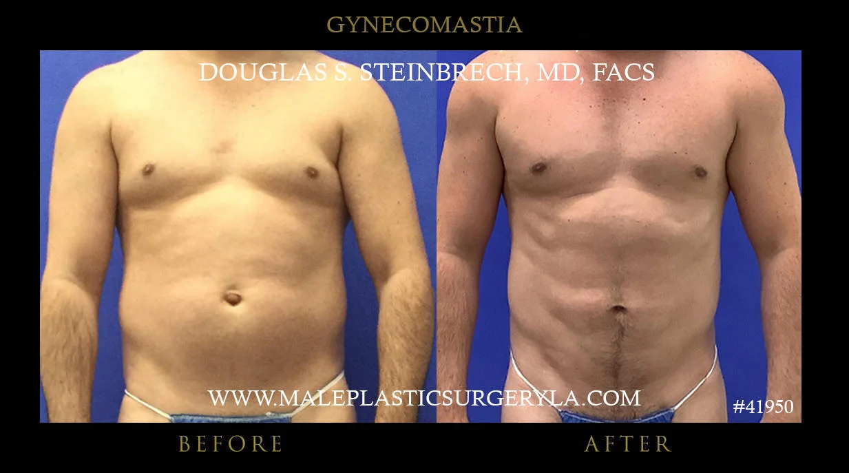 Gynecomastia - Before & After Photos