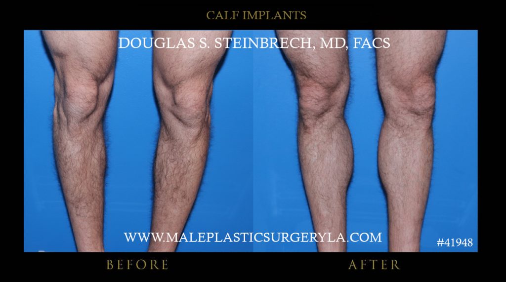 Calf Implants Before and After Photos