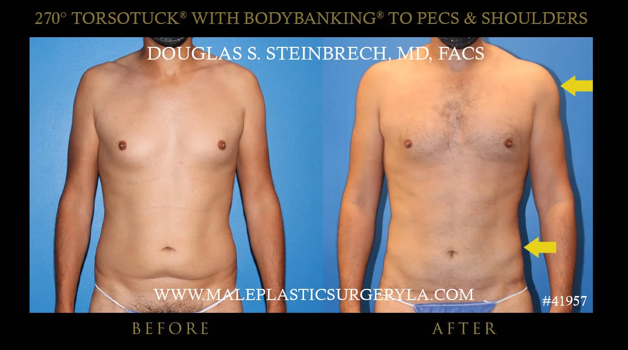 Gynecomastia - Before & After Photos