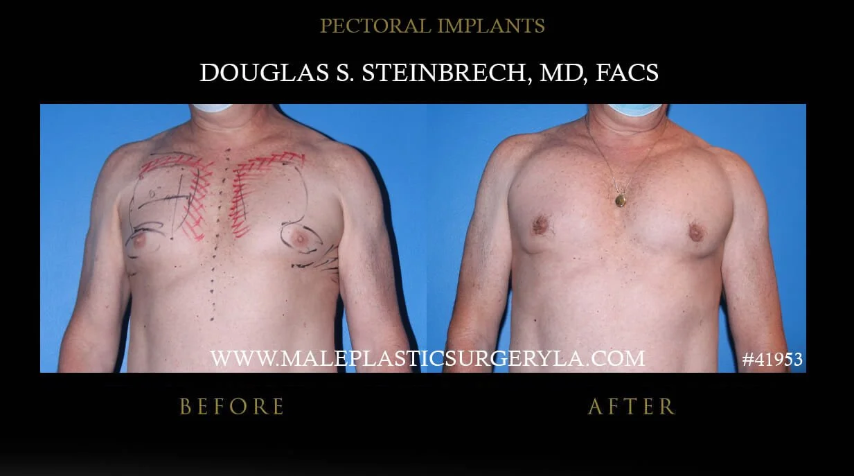 Pectoral Chest Implant - Before & After Photos