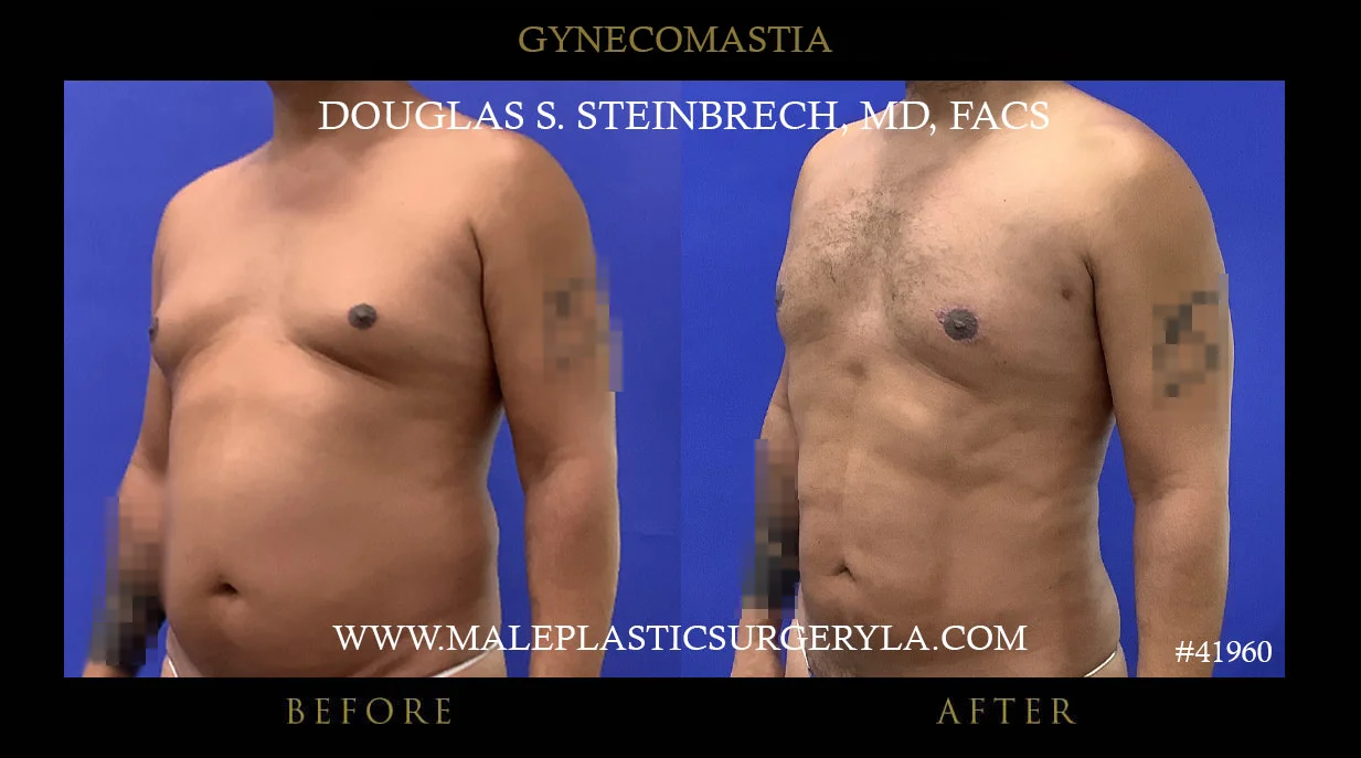 Gynecomastia - Before & After Photos