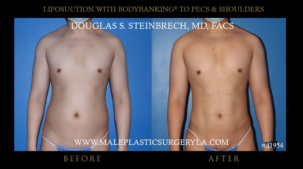 Liposuction - Before & After Photos