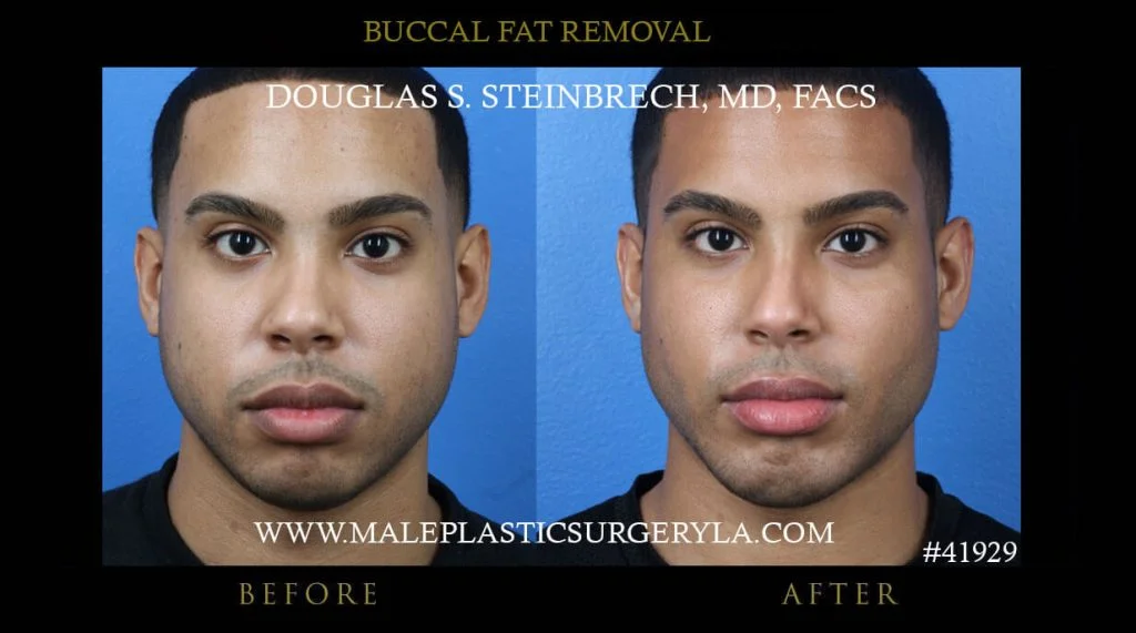 Buccal Fat Removal - Before & After Photos