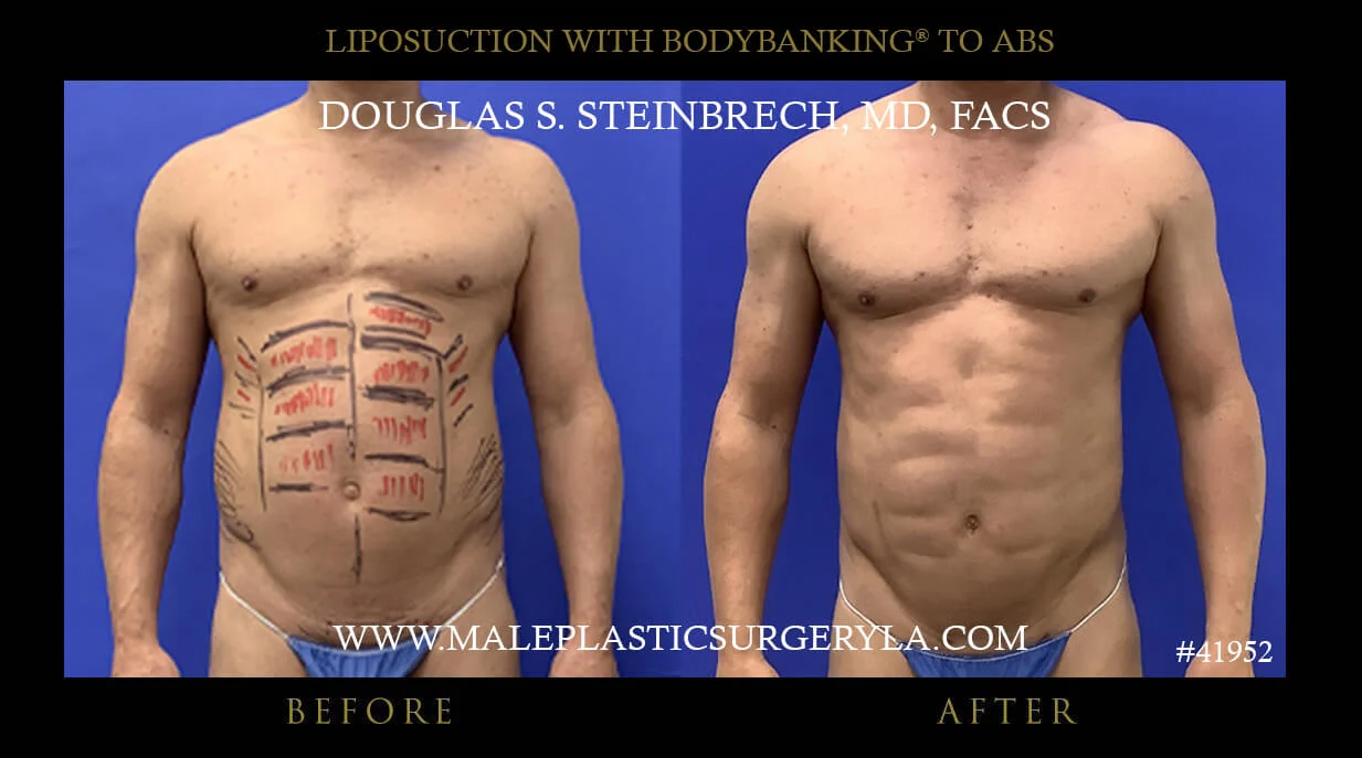 Liposuction - Before & After Photos