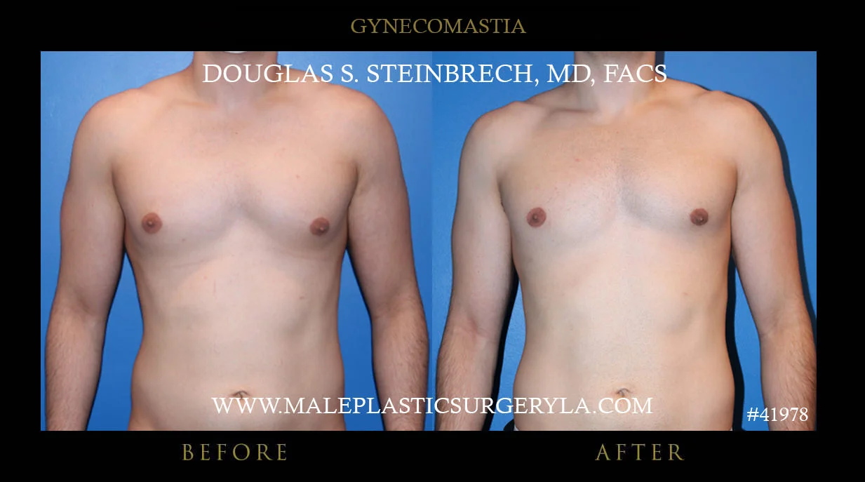 Gynecomastia - Before & After Photos