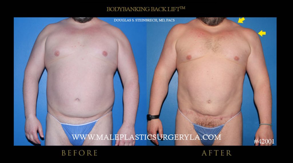 BodyBanking Back Lift - Before & After Photos