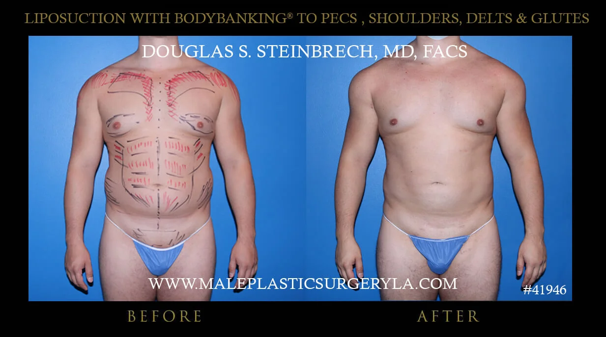 Liposuction - Before & After Photos