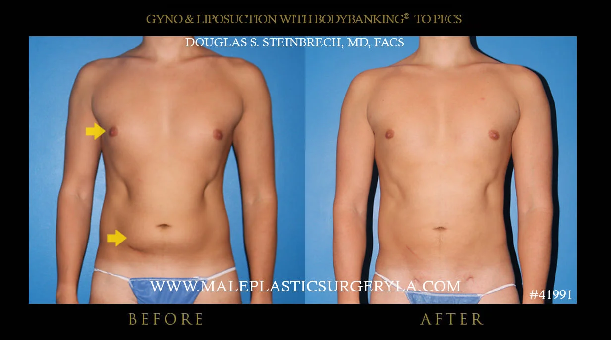 Gynecomastia - Before & After Photos