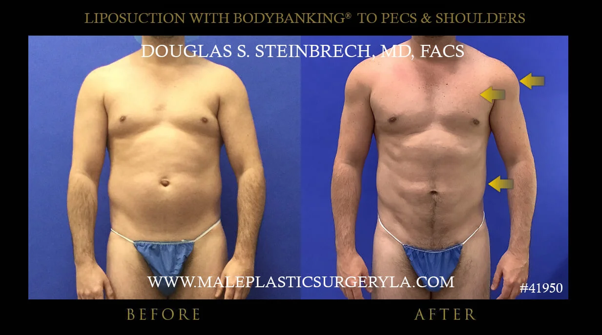 Liposuction - Before & After Photos