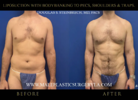 1-lipo-bodybanking-to-pecs-shoulders-traps-anterior-view-la