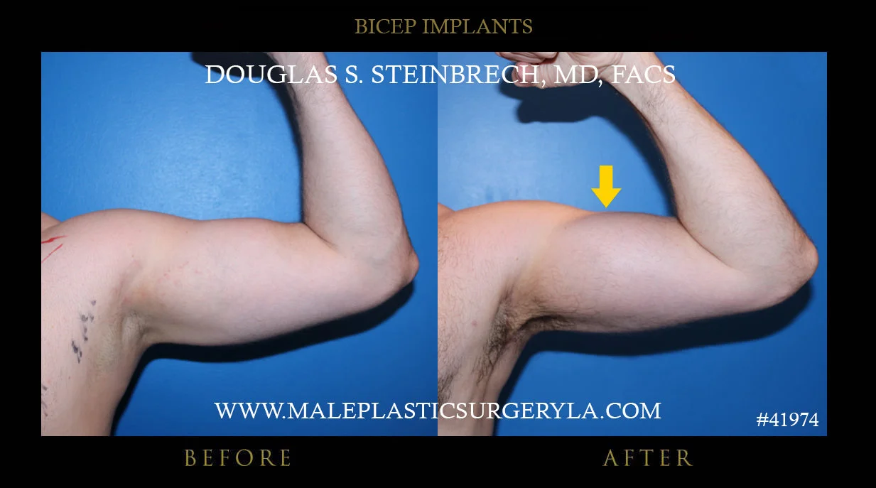 Bicep Implants - Before & After Photos