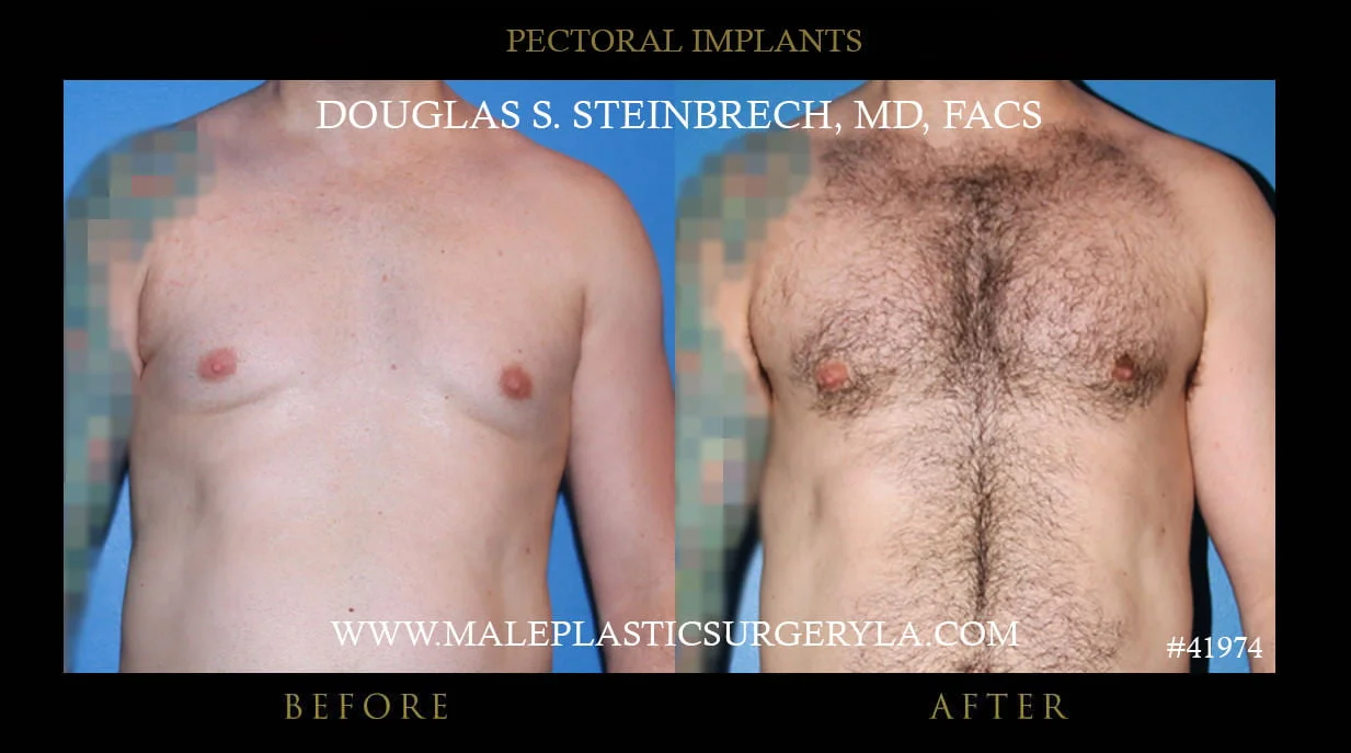 Pectoral Chest Implant - Before & After Photos