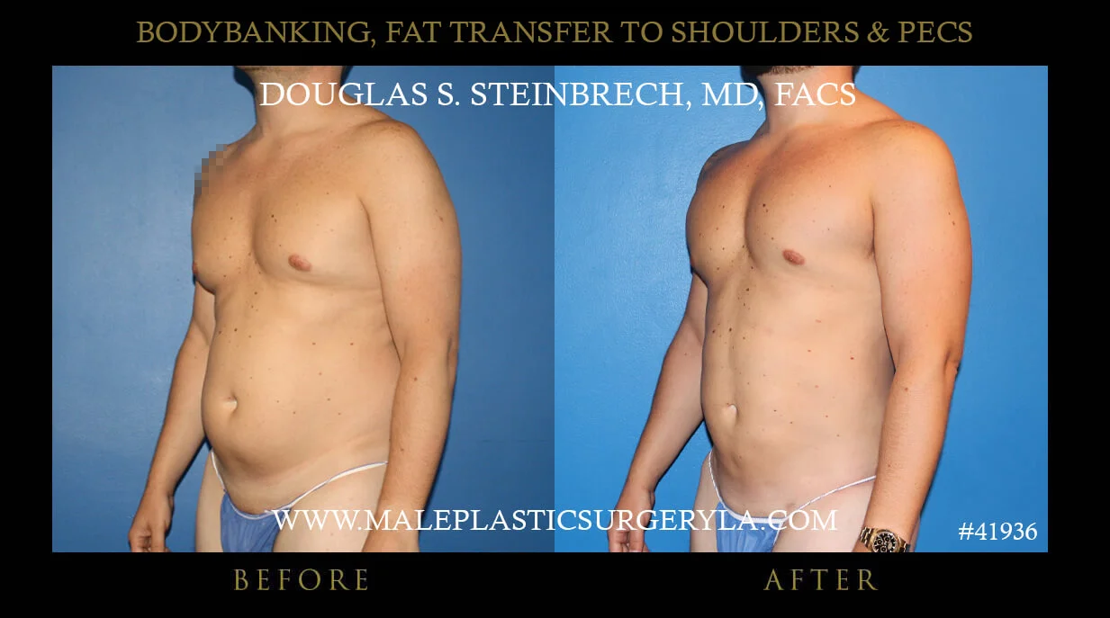 Liposuction - Before & After Photos