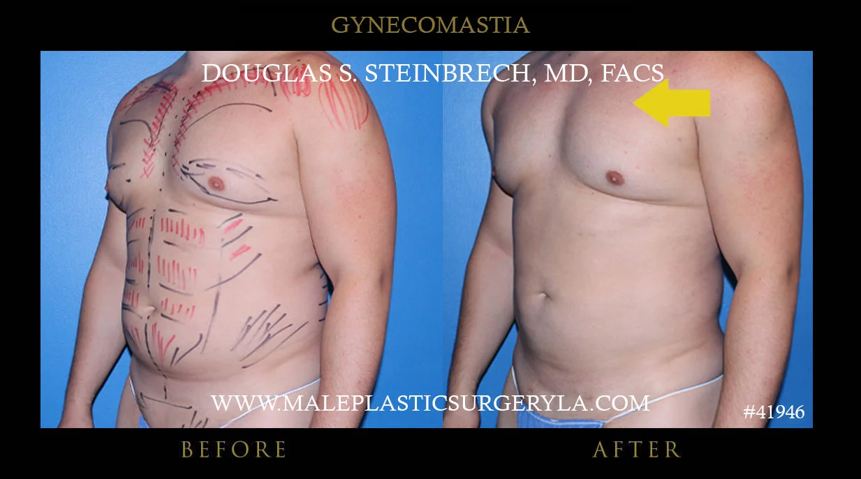 Gynecomastia - Before & After Photos