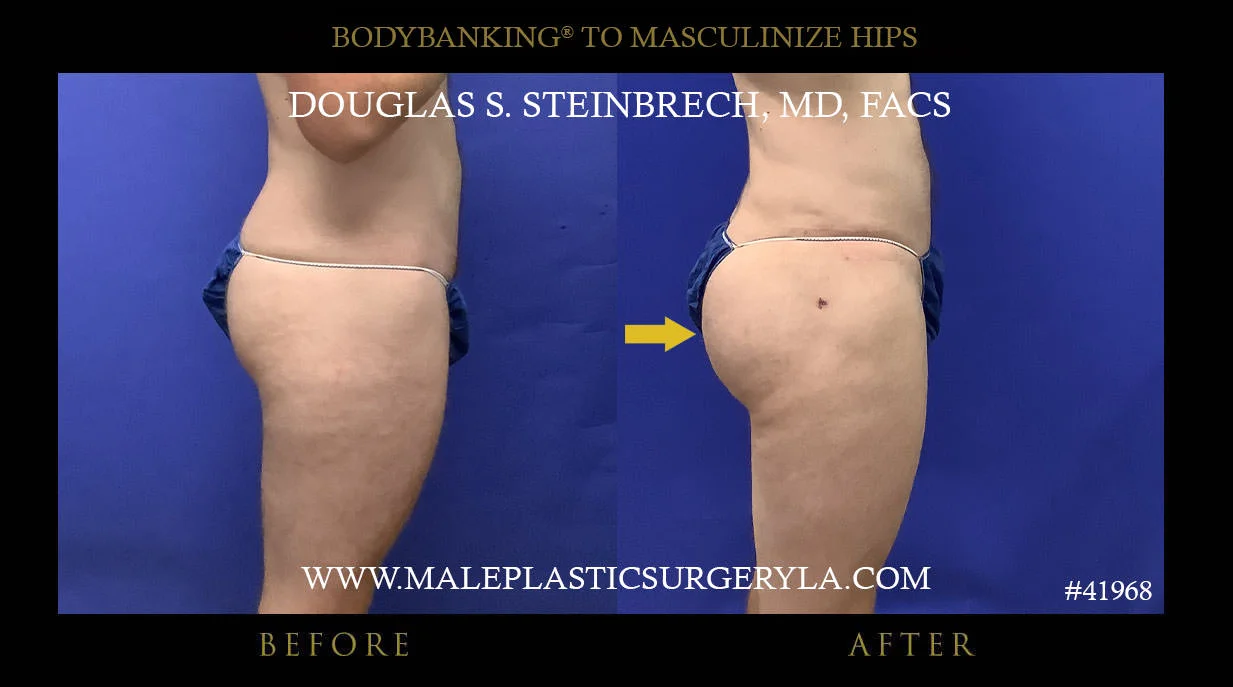 Liposuction - Before & After Photos