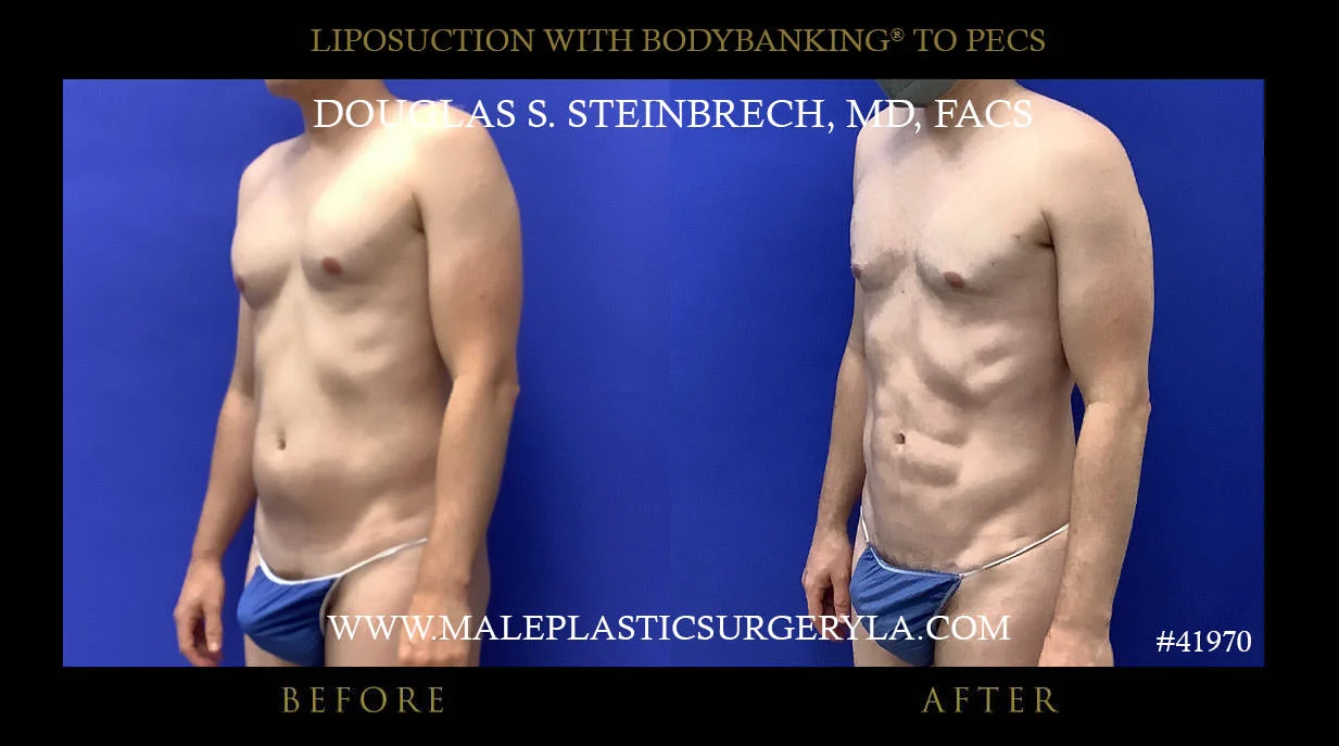 Liposuction - Before & After Photos