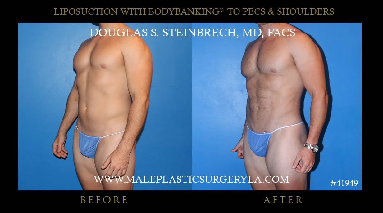 Liposuction - Before & After Photos