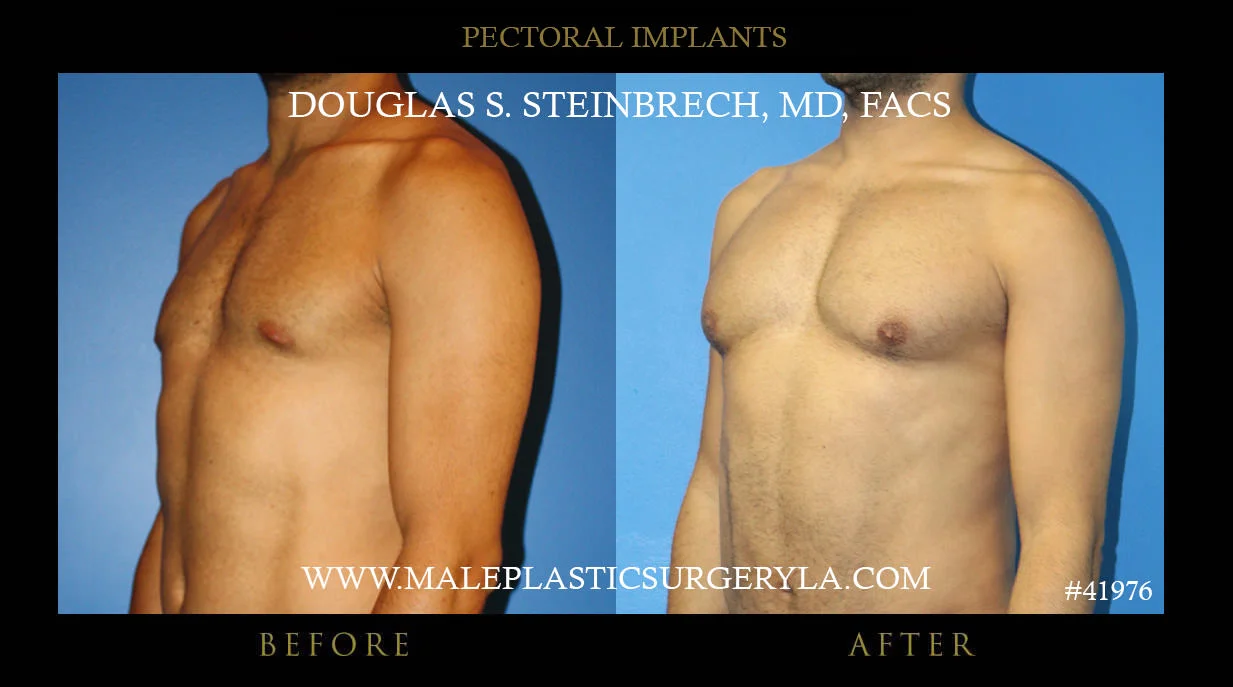 Pectoral Chest Implant - Before & After Photos