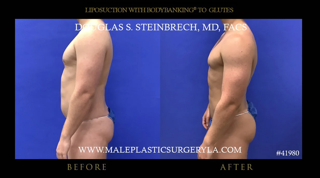 Liposuction - Before & After Photos