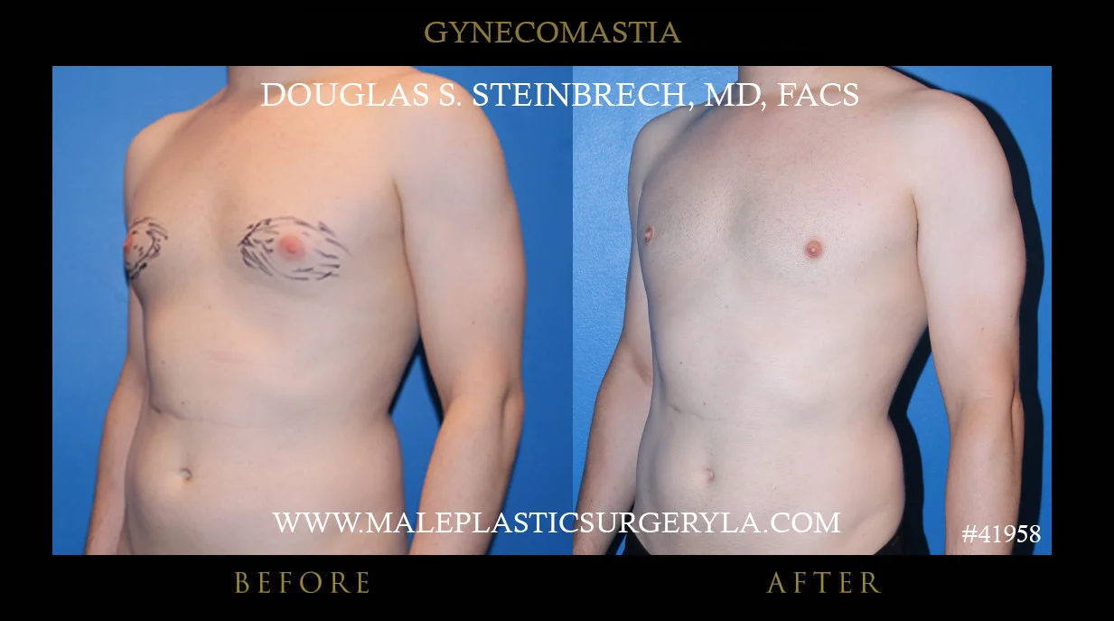 Gynecomastia - Before & After Photos