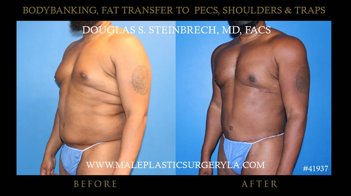 Liposuction - Before & After Photos