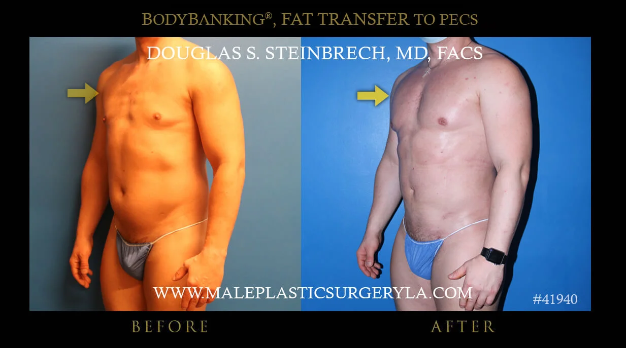 Liposuction - Before & After Photos