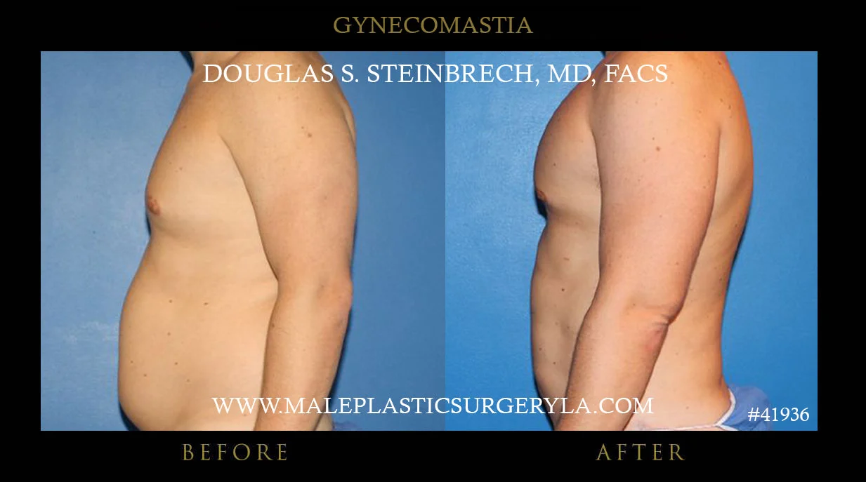 Gynecomastia - Before & After Photos