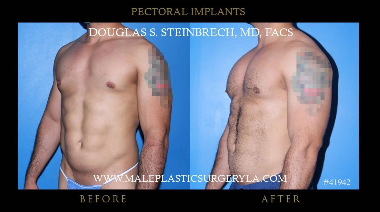 Pectoral Chest Implant - Before & After Photos