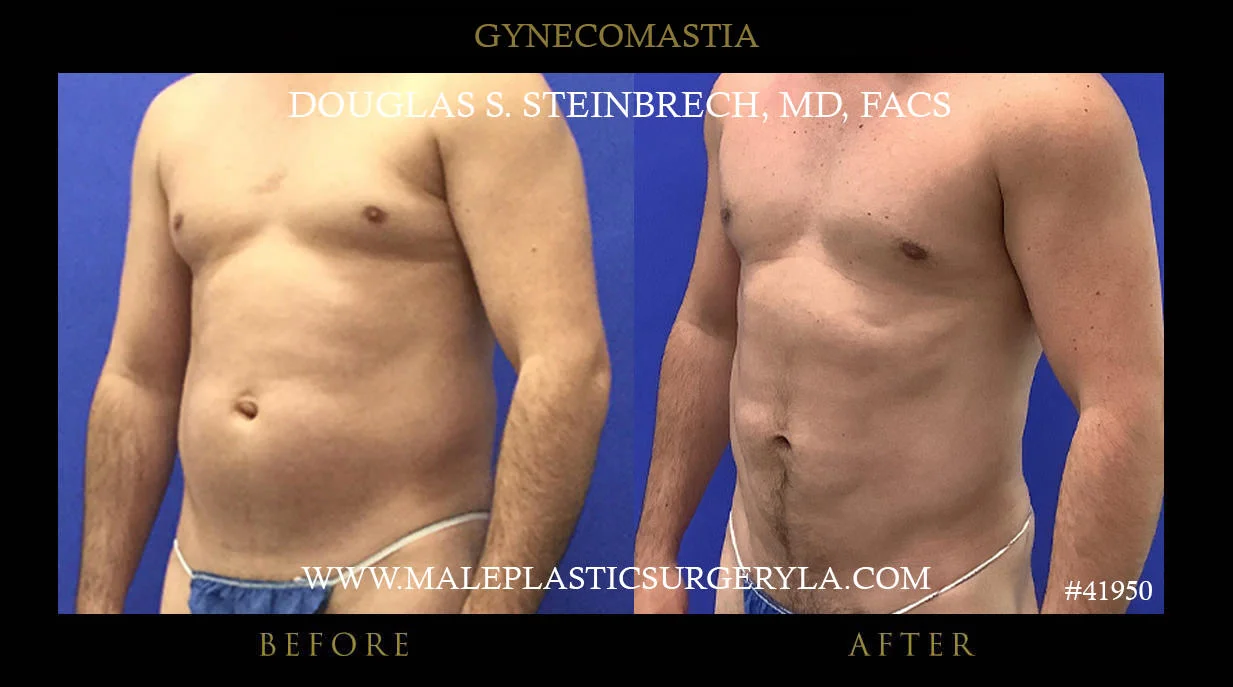 Gynecomastia - Before & After Photos