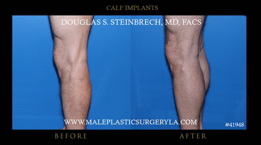 Calf Implants Before and After Photos