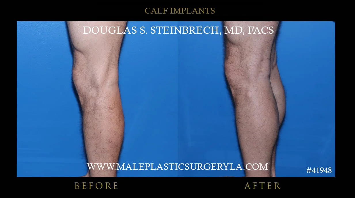 Calf Implants Before and After Photos