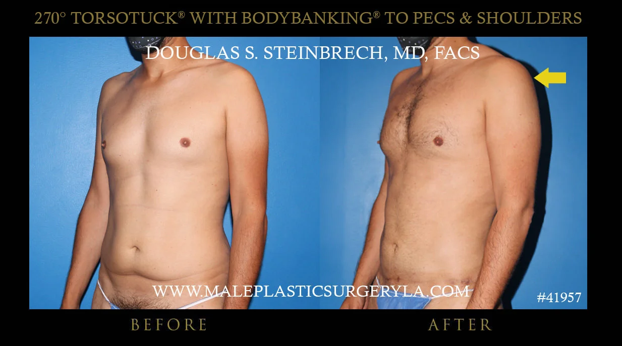 Gynecomastia - Before & After Photos