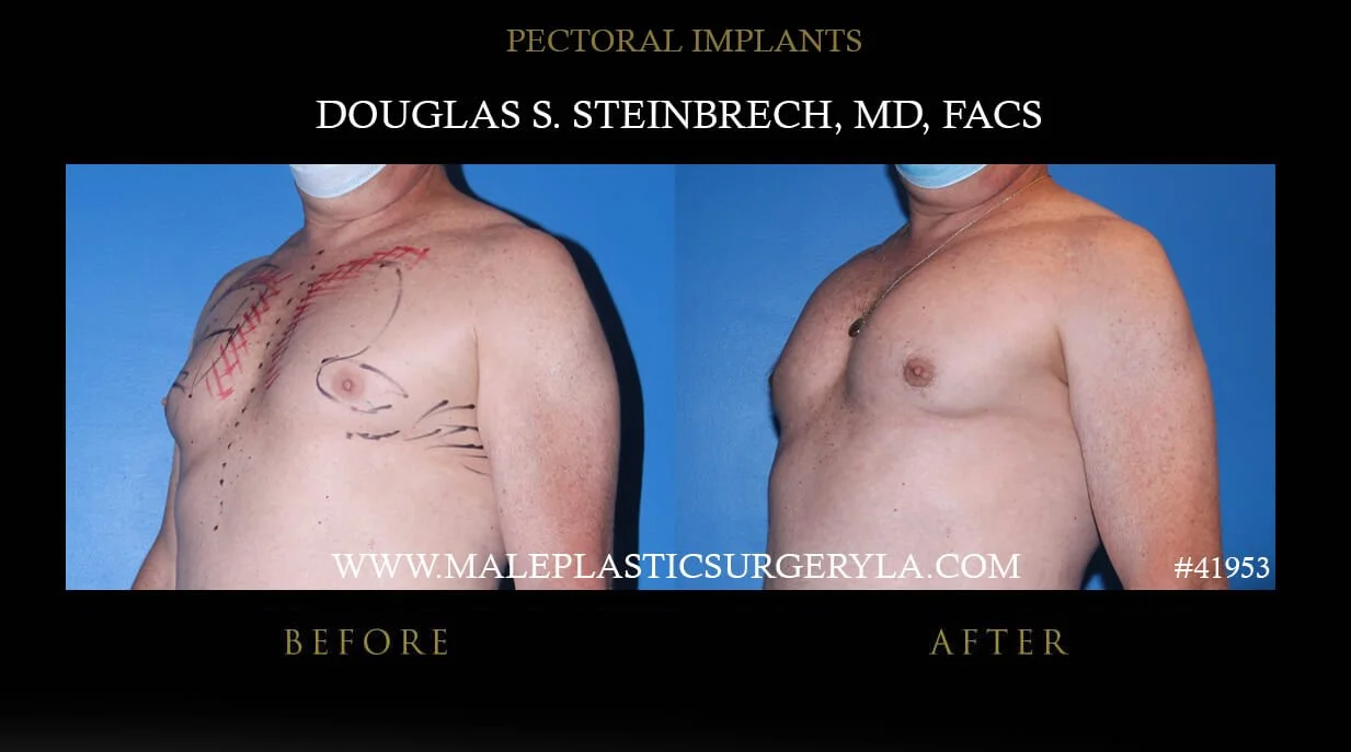 Pectoral Chest Implant - Before & After Photos