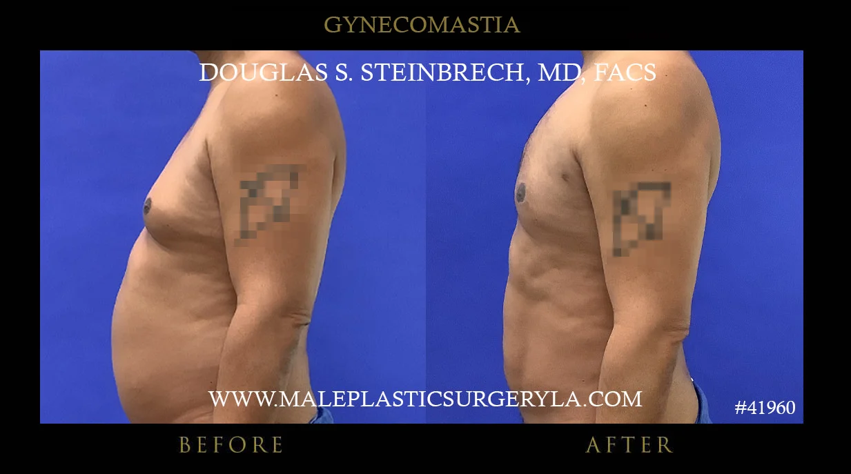 Gynecomastia - Before & After Photos