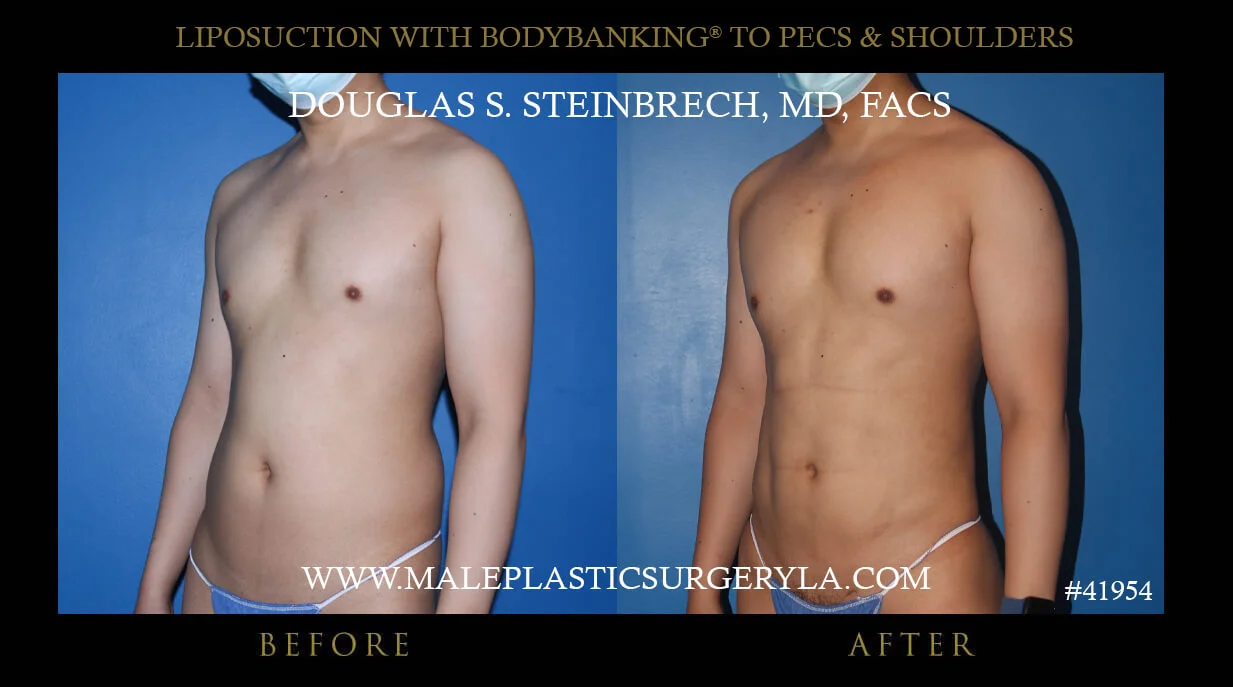 Liposuction - Before & After Photos