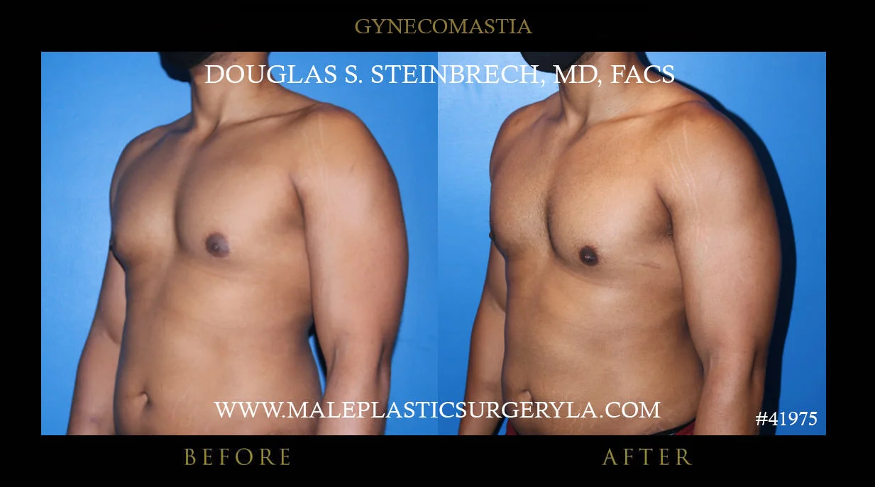 Gynecomastia - Before & After Photos