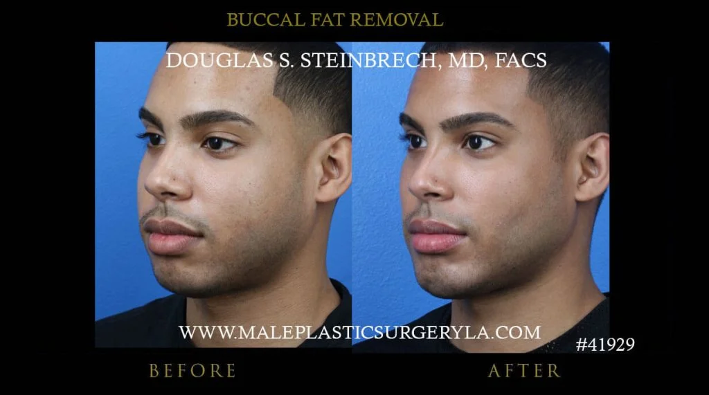 Buccal Fat Removal - Before & After Photos