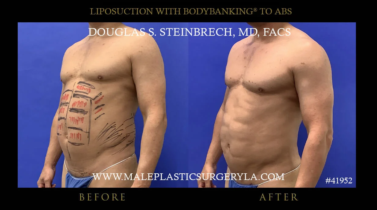 Liposuction - Before & After Photos